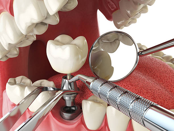 Best Emergency Broken Tooth Repair in Sandoval, IL